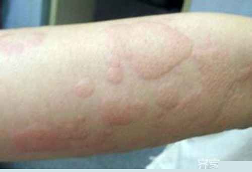 艾蒿过敏怎么治疗 可惜很多人还不知道